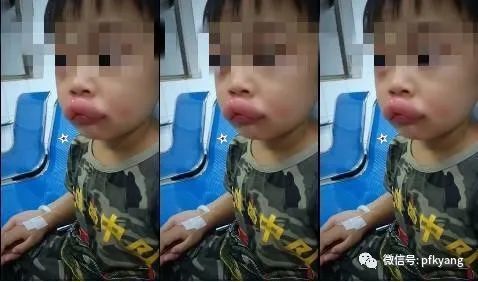 男孩吃葡萄過敏腫成嘟嘟嘴怎么回事？畫面詳情曝光網(wǎng)友忍不住笑了(圖1)